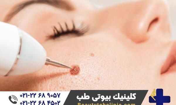 عکس دستگاه لیزر خال