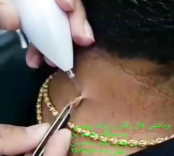 عکس دستگاه لیزر خال