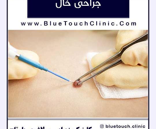 عکس دستگاه لیزر خال