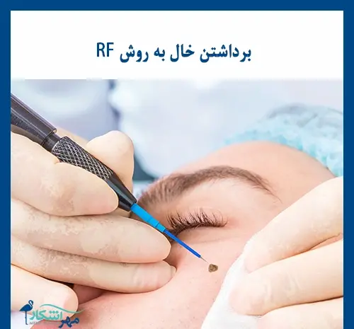 عکس دستگاه لیزر خال
