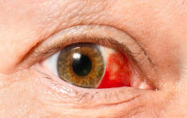 عکس صلبیه چشم
