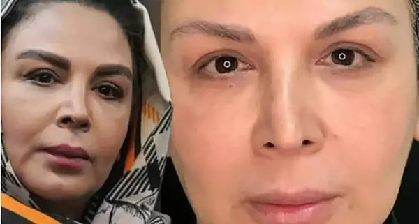 عکس ژاله صامتی بعد از عمل بینی