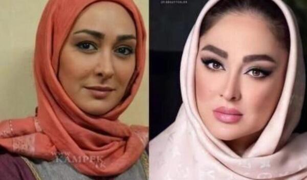 عکس ژاله صامتی بعد از عمل بینی