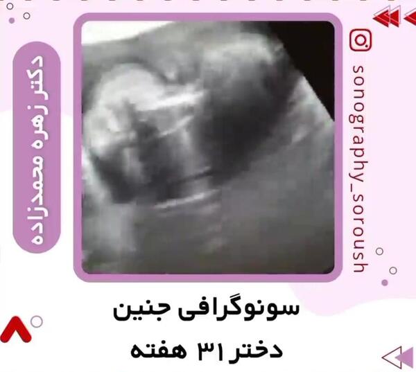 عکس جنین پسر سی هفته