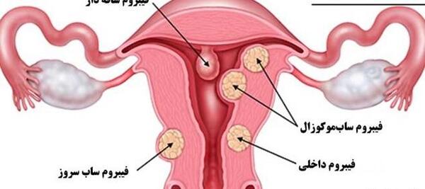 عکس فیبروم دفع شده نی نی سایت