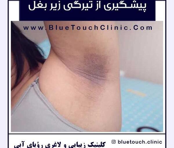 عکس سفیدی زیر بغل