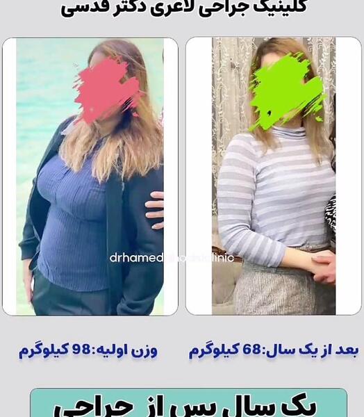 عکس قبل و بعد چاقی
