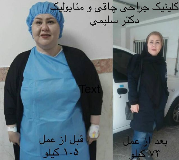 عکس قبل و بعد چاقی