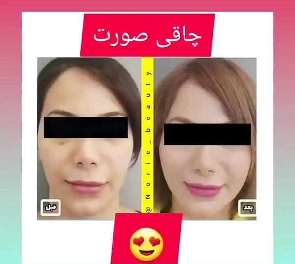 عکس قبل و بعد چاقی