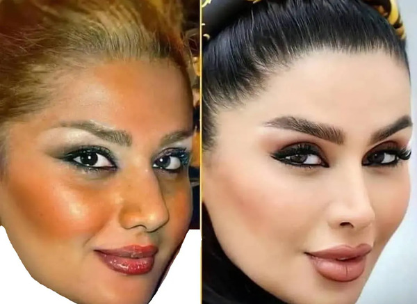 عکس دنیا جهانبخت قبل از عمل زیبایی
