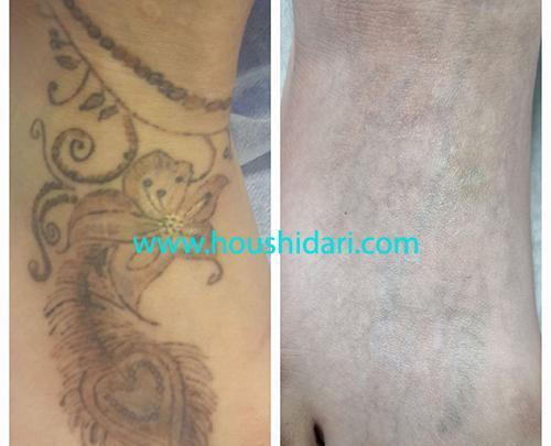 عکس تاتو دست چگونه پاک میشود