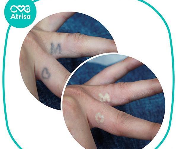 عکس تاتو دست چگونه پاک میشود