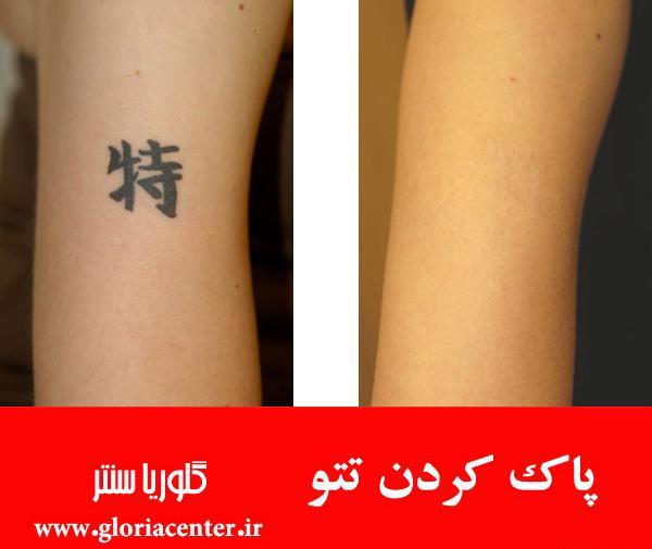 عکس تاتو دست چگونه پاک میشود