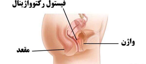 عکس داخل رحم دختر