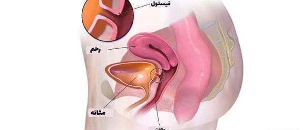 عکس داخل رحم دختر