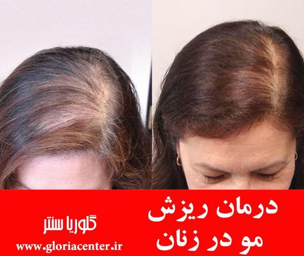 عکس دختر ریزش مو