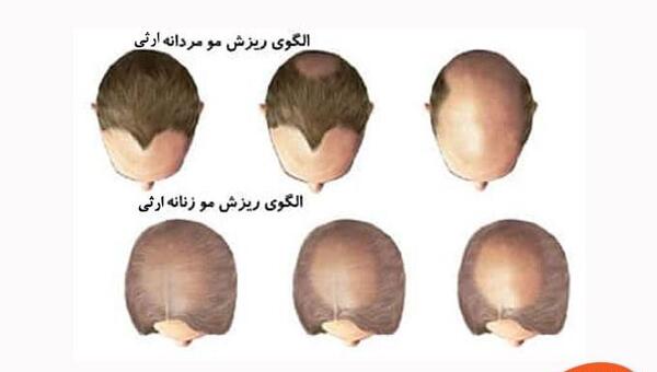 عکس دختر ریزش مو