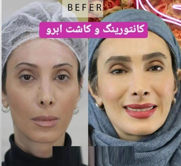 عکس سحر ساغرچی قبل از عمل