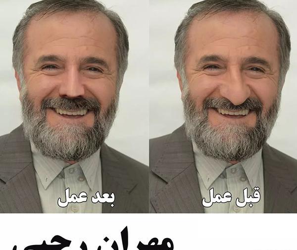 عکس برزو ارجمند قبل از عمل بینی