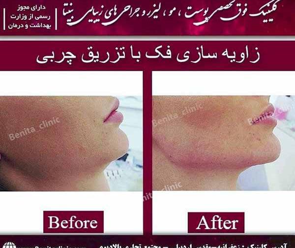عکس های قبل و بعد از تزریق چربی