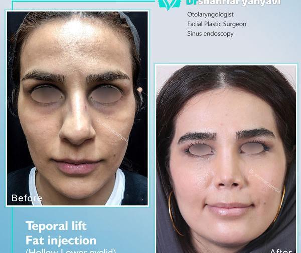 عکس های قبل و بعد از تزریق چربی
