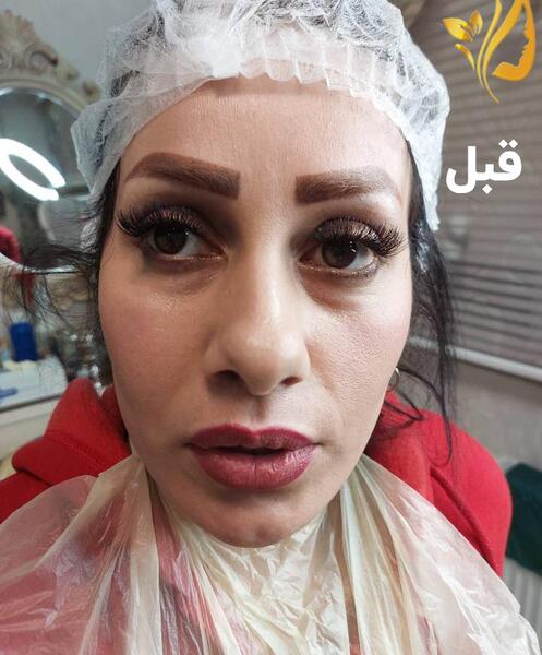 عکس های قبل و بعد از تزریق چربی