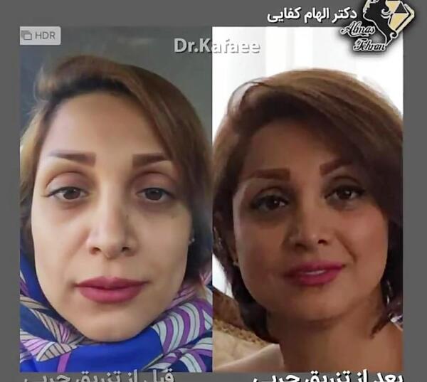 عکس های قبل و بعد از تزریق چربی
