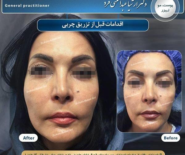 عکس های قبل و بعد از تزریق چربی