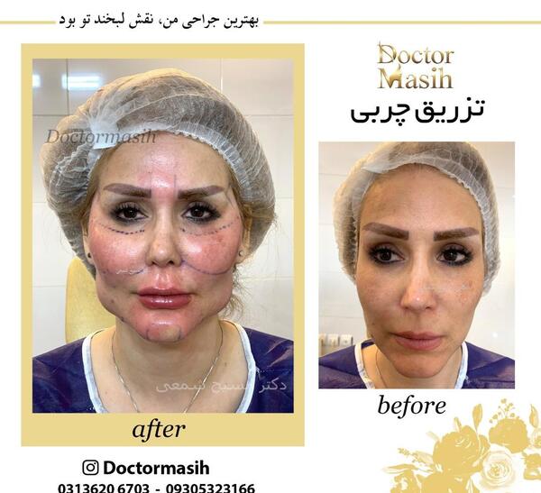 عکس های قبل و بعد از تزریق چربی