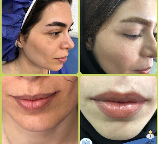 عکس های قبل و بعد از تزریق چربی