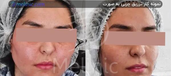 عکس های قبل و بعد از تزریق چربی