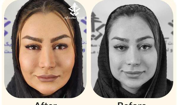 عکس های قبل و بعد از تزریق چربی