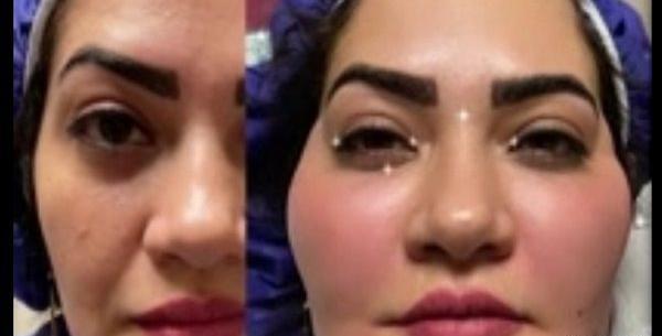 عکس های قبل و بعد از تزریق چربی