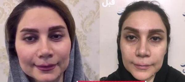 عکس های قبل و بعد از تزریق چربی