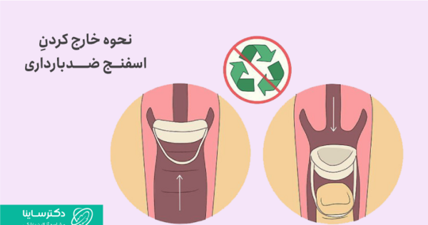 عکس اسفنج ضد بارداری
