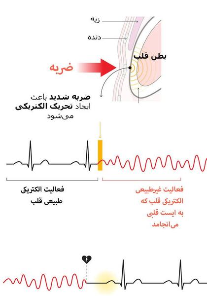 ايست قلبي عکس ضربان قلب در حال مرگ