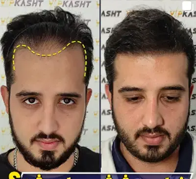 عکس یک هفته بعد از کاشت مو