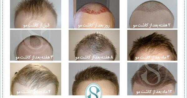 عکس یک هفته بعد از کاشت مو