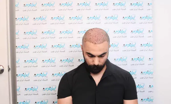 عکس یک هفته بعد از کاشت مو