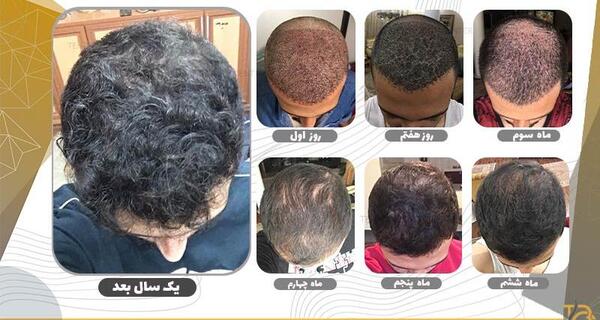 عکس یک هفته بعد از کاشت مو