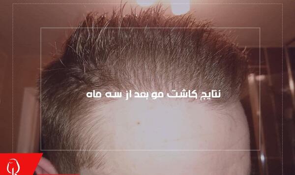 عکس یک هفته بعد از کاشت مو