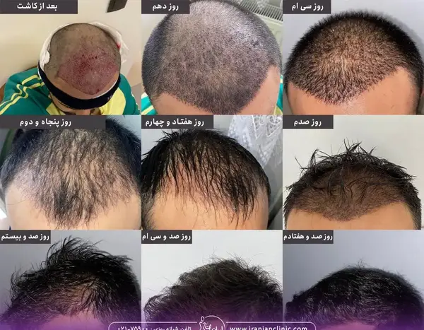 عکس یک هفته بعد از کاشت مو
