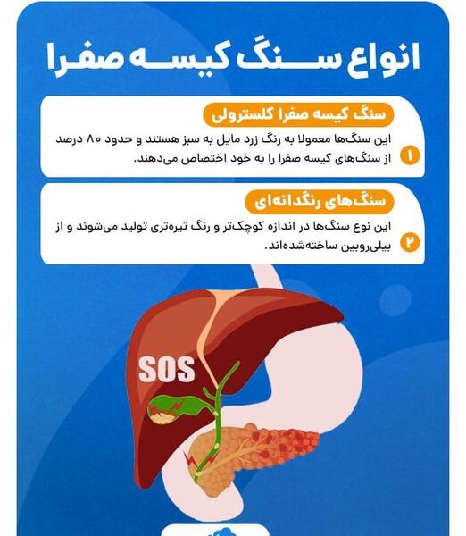 عکس سنگ صفرا
