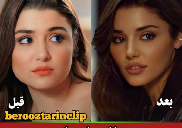 عکس هانده ارچل بعد از عمل