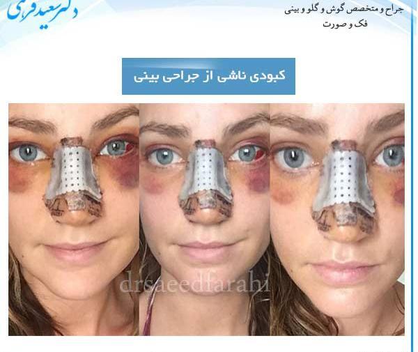 عکس روز اول عمل بینی