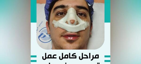 عکس روز اول عمل بینی