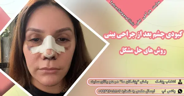 عکس روز اول عمل بینی