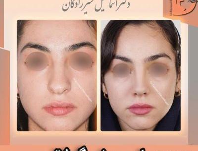 عکس روز اول عمل بینی