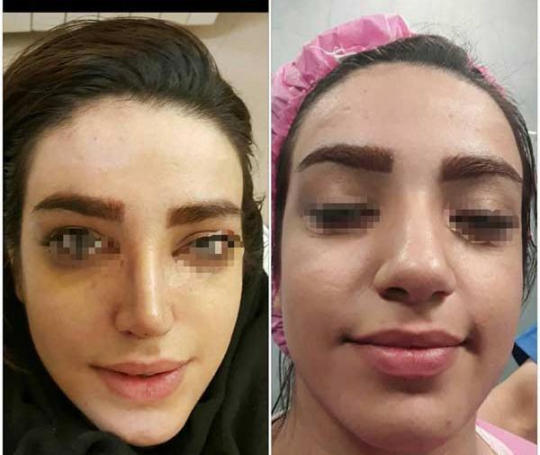 عکس روز اول عمل بینی