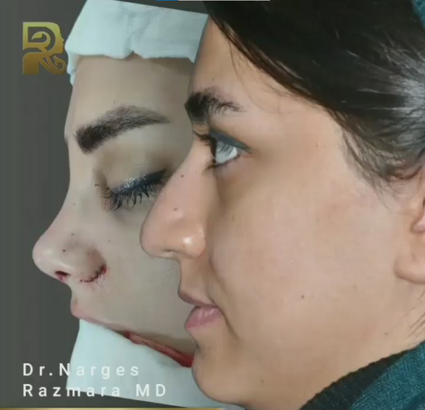 عکس روز اول عمل بینی
